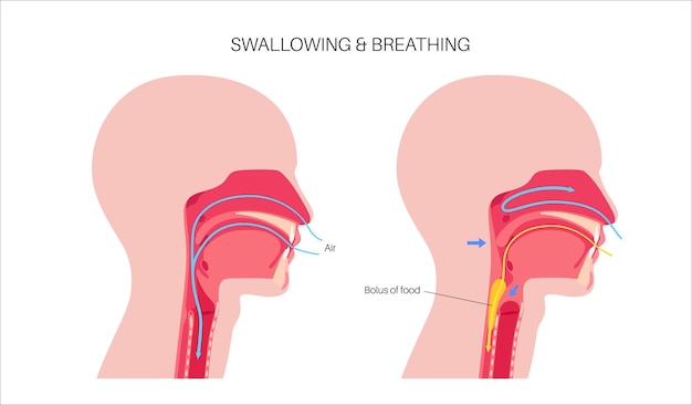 An illustration depicting the difference between a normal airway and an obstructed airway during sleep apnea, highlighting the anatomical structures involved.